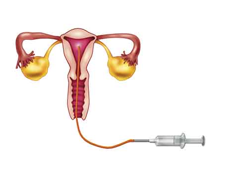 3个特征教您判断多囊卵巢综合征！