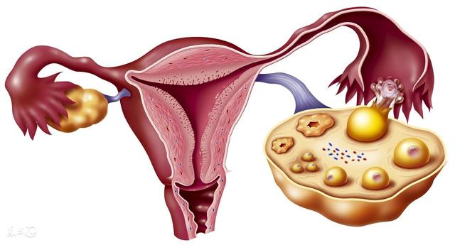 如果女性被诊断为多囊，应该如何治疗？是不是有个体化之分？