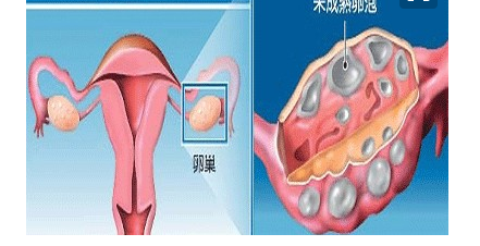 卵巢囊肿需要处理才能再次做试管婴儿？